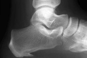 Fitness – Fersensporn behandeln