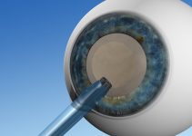 Katarakt-OP – Brille ade