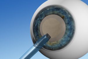 Katarakt-OP – Brille ade