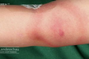 So schützt Ihr Euch vor Zecken