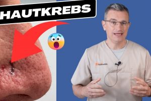 Segeln ist gefährlich – Basaliom am Nasenflügel wurde entfernt